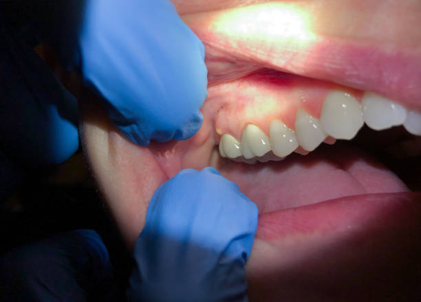 Best Emergency Cosmetic Dentistry (e.g., broken veneers) in Wenonah, NJ